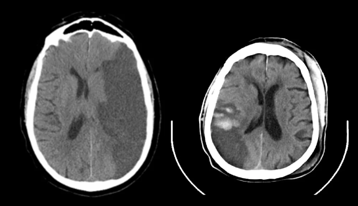 Foto de uma RNM com uma área acometida por AVC isquêmico